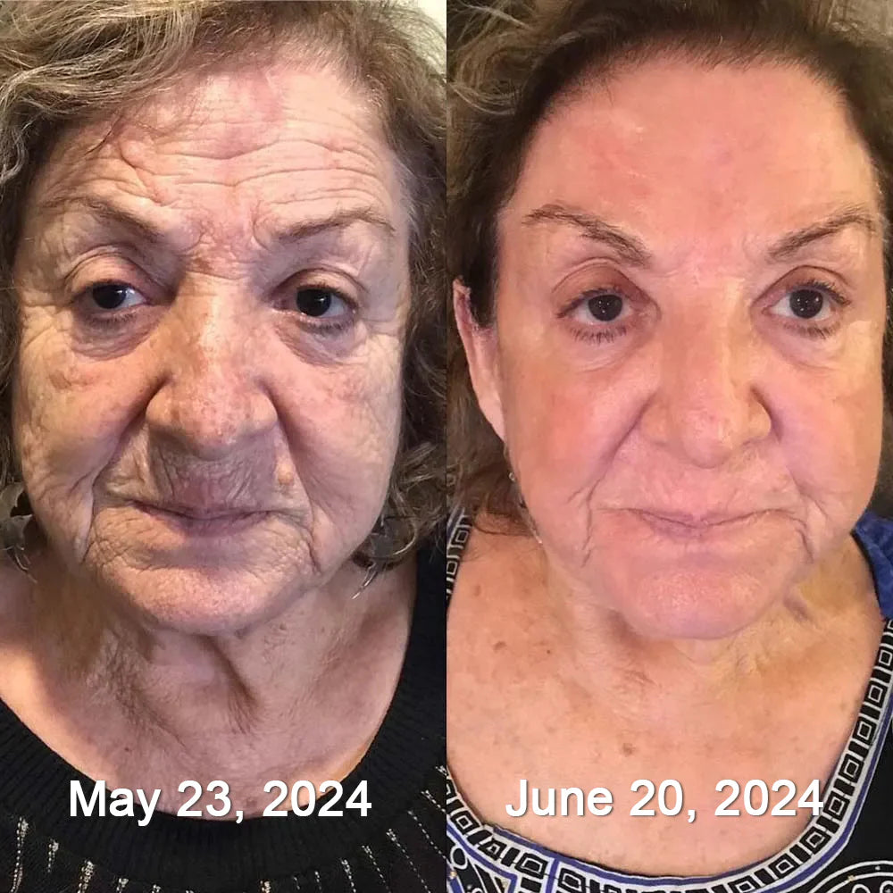 BOTOX BEE VENOM REJUVENECE Y CURA !!ENVÍO GRATIS!!